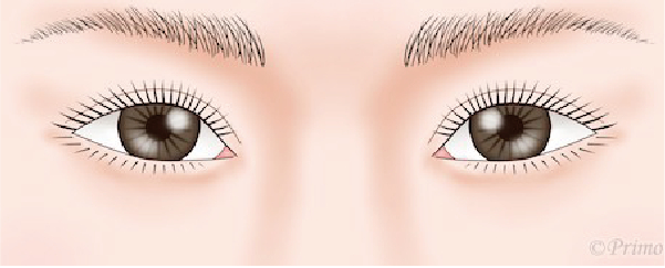 下眼瞼拡大術（たれ目形成）の目元イラスト